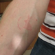 Image for article titled Man Gives Himself A Tattoo By Letting 1,000 Bed Bugs Feed On Him